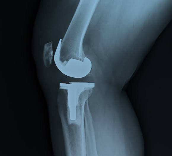 Joint Replacement Assessment